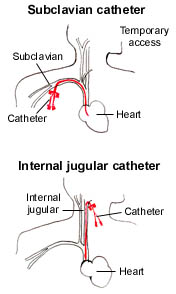 CRRT diagram